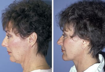 Facelift