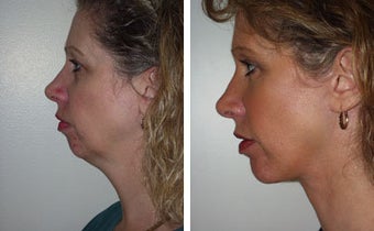 Facelift with Chin Implant, Dermabrasion