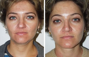 Neck Lift and Chin Implant