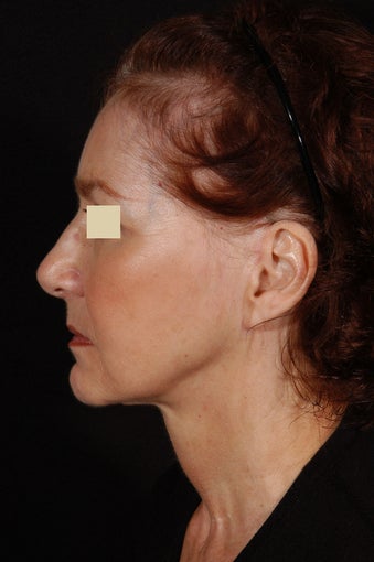 Liposuction of Neck