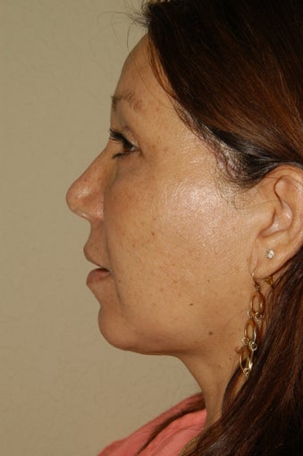 Liposuction of the Neck