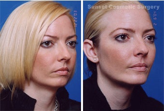 Submental Liposuction (chin/neck) with Chin Implant