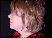 chin liposuction  with platysmal plication (mini necklift)