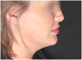 chin lipo with platysmal plication (mini necklift)