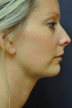 Jawline / Neck Lipo