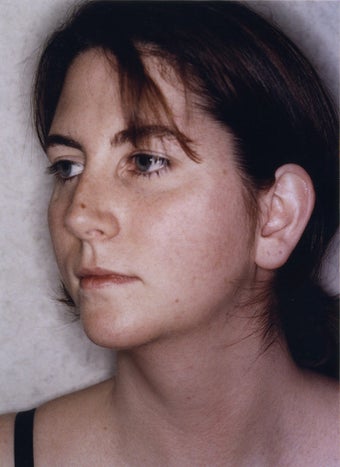 Neck Liposuction