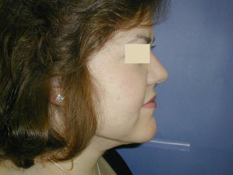 Neck Liposuction