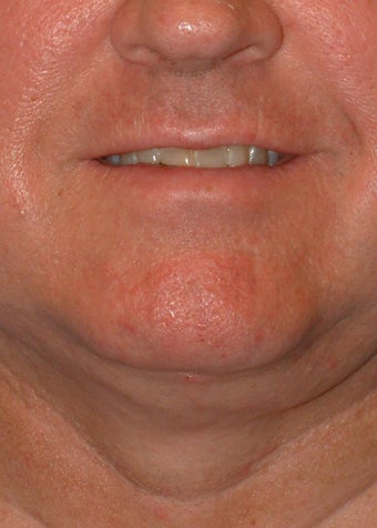 Liposuction