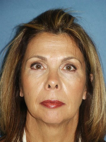 Chin augmentation with facial rejuvenation