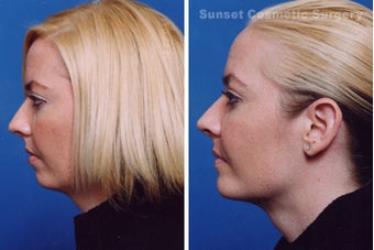 Submental Liposuction (chin/neck) with Chin Implant