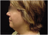 chin liposuction  with platysmal plication (mini necklift)
