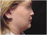 chin lipo with platysmal plication (mini necklift)