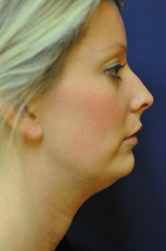 Jawline / Neck Lipo