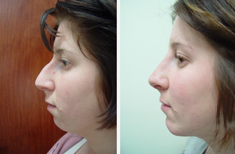 22 year old female who underwent liposuction of face and neck