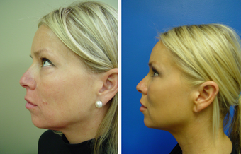 36 year old female who underwent liposuction of face