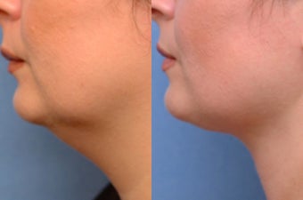 Chin liposuction