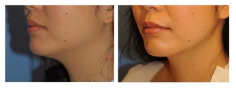 Chin Liposuction