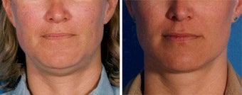 Chin Liposuction