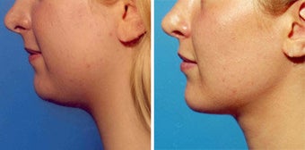 Chin Liposuction