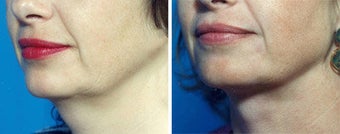 Chin Liposuction