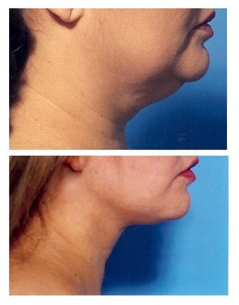 Chin Liposuction