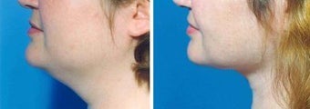 Chin Liposuction