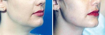 Chin Liposuction