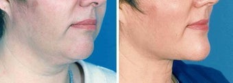Chin Liposuction