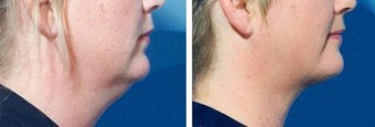 Chin Liposuction