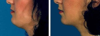 Chin Liposuction