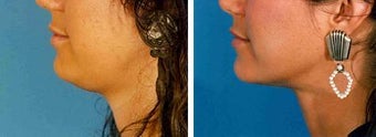Chin Liposuction