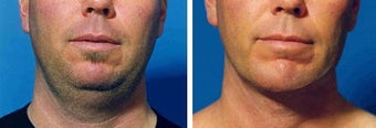Chin Liposuction