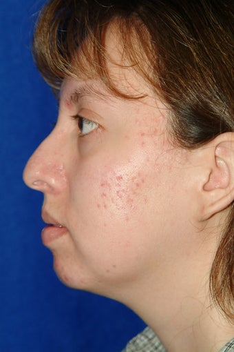 Rhinoplasty, chin implant, chin liposculpture, cheek fat pad removal