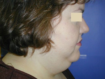 Neck Liposuction