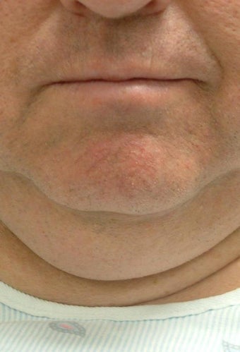 Liposuction