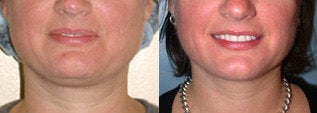 Liposuction (chin and jaw line)