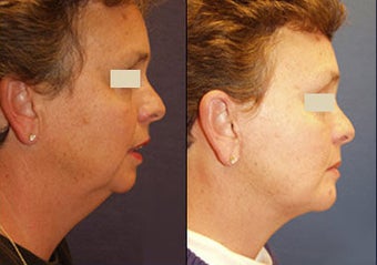 Chin Augmentation