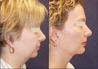 Chin Augmentation