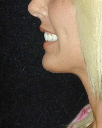 Chin Surgery 