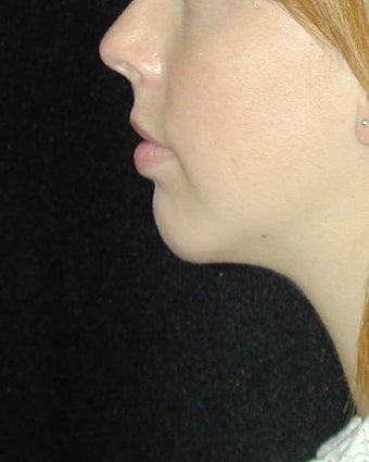 Chin Implant