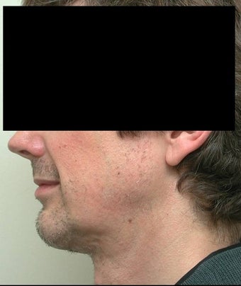 Neck Lift and Chin Implant