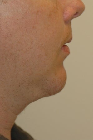 Chin augmentation, neck liposuction, and neck muscle tightening
