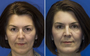 Chin Implantation with Rhinoplasty and upper lid blepharoplasty