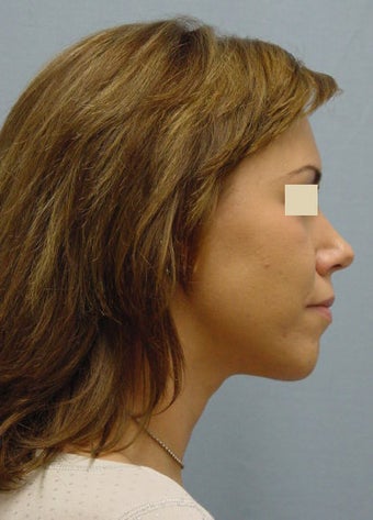 Chin Augments