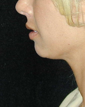 Chin Surgery 