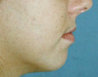 Chin Augmentation