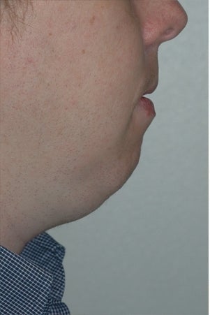 Chin augmentation, neck liposuction, and neck muscle tightening