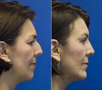Chin Implantation with Rhinoplasty and upper lid blepharoplasty