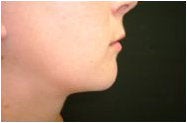 Chin Implant