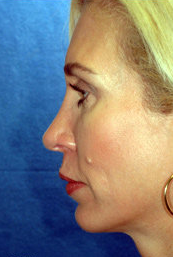 Chin Implant and Rhinoplasty